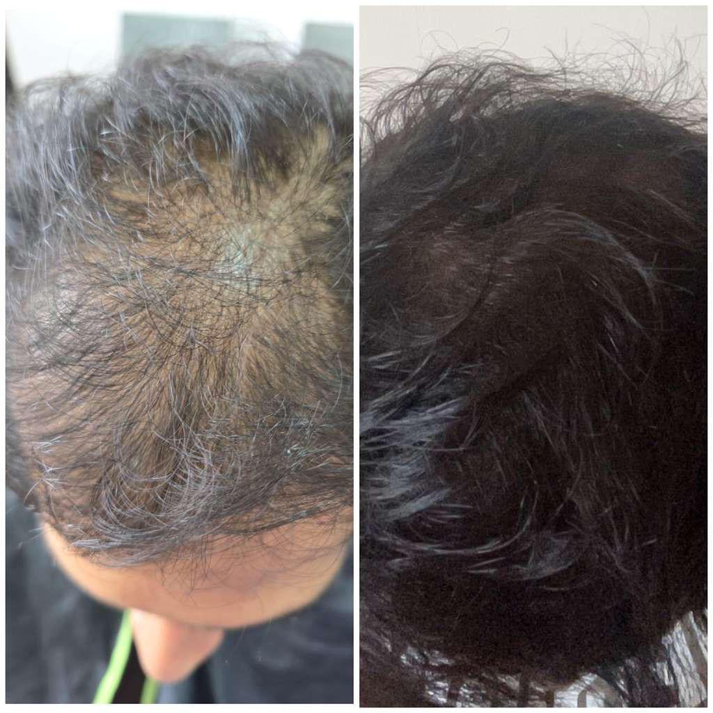 Kaira customer before and after hair regrowth result