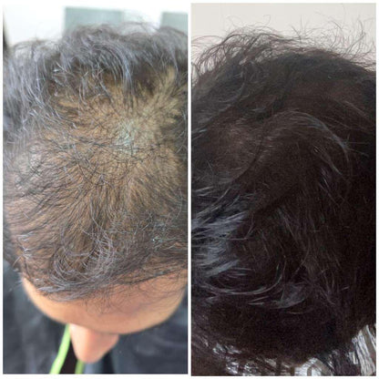 Kaira customer before and after hair regrowth result