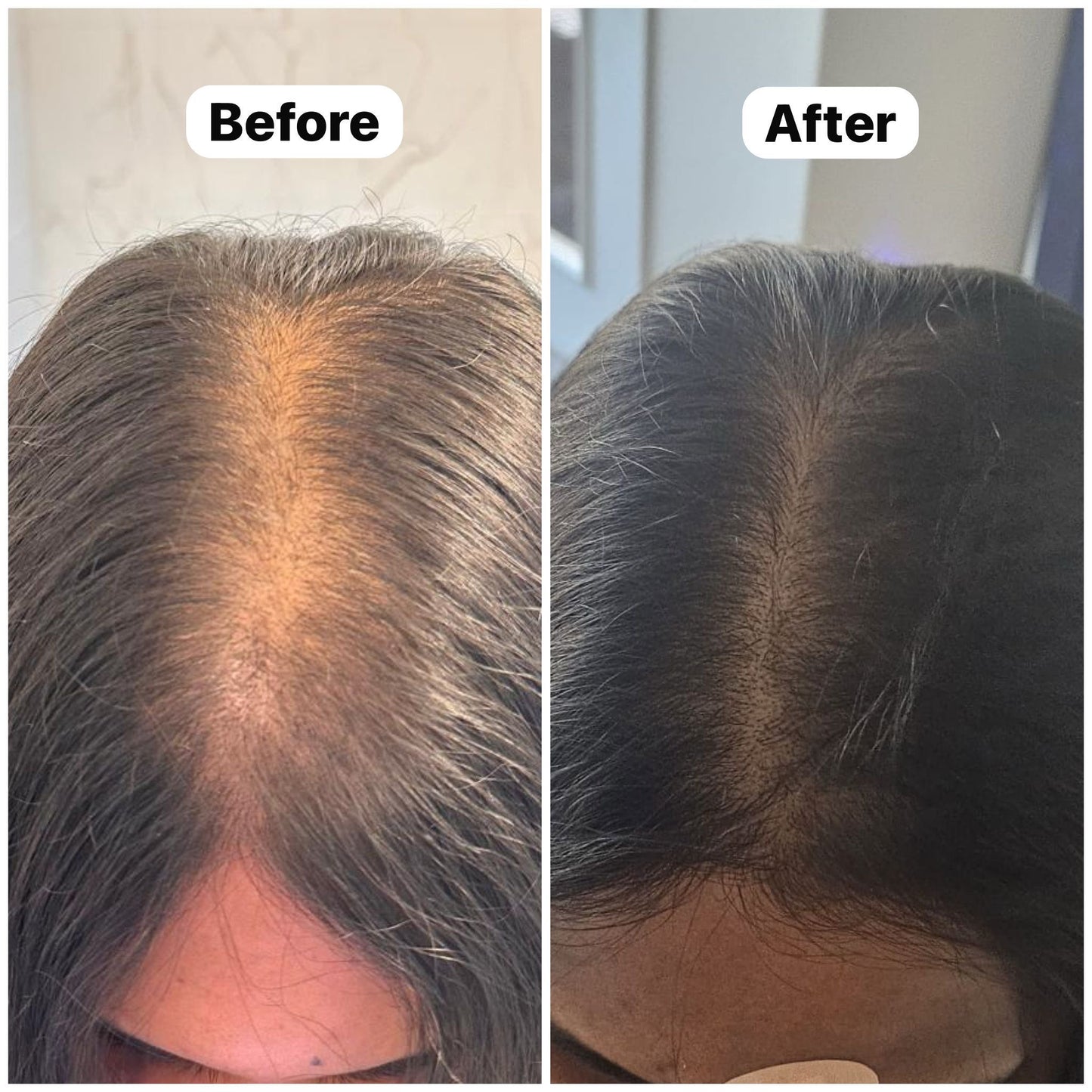 Kaira customer before and after hair regrowth result