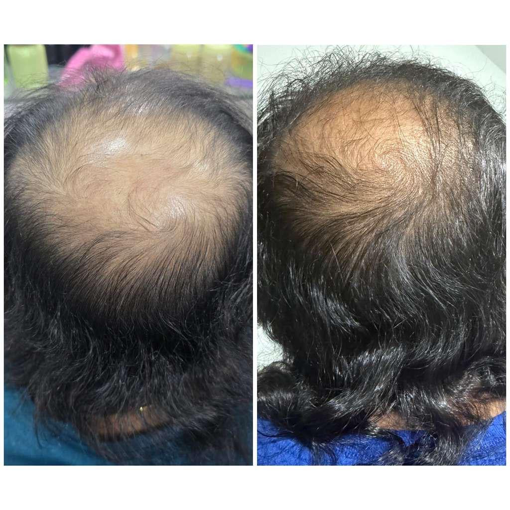 Kaira customer before and after hair regrowth result