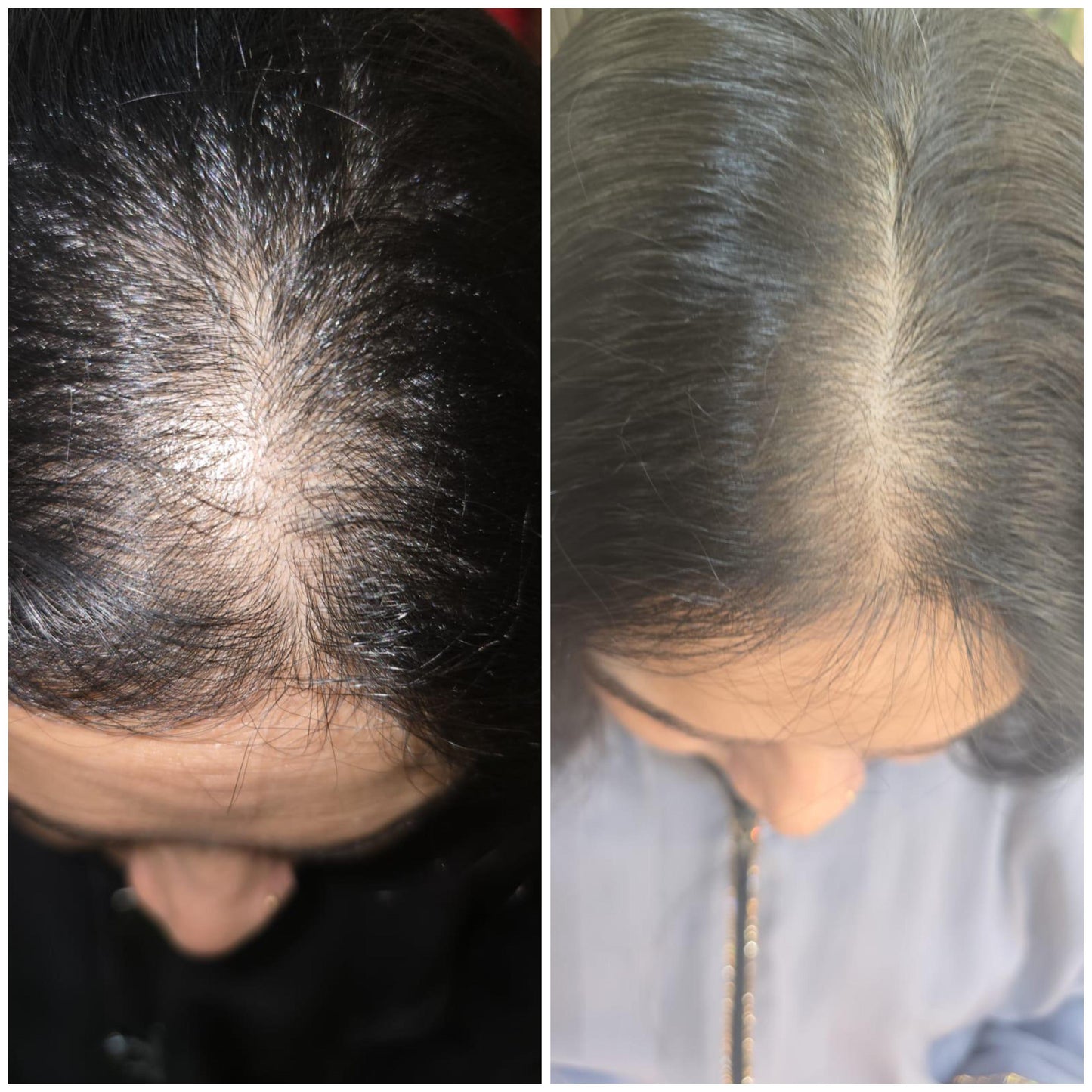 Kaira customer before and after hair regrowth result